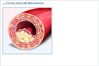 Coronary artery with atherosclerosis
