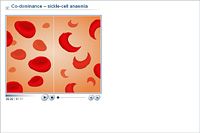 Co-dominance – sickle-cell anaemia