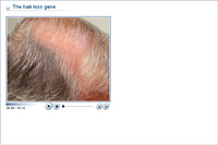 The hair loss gene