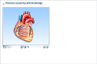 Illnesses caused by arterial damage