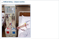 Artificial kidney – dialysis machine
