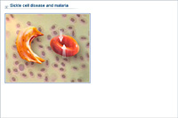 Sickle cell disease and malaria